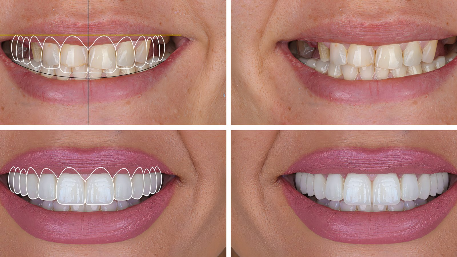 Projet numérique de sourire (smile design) avant traitement esthétique