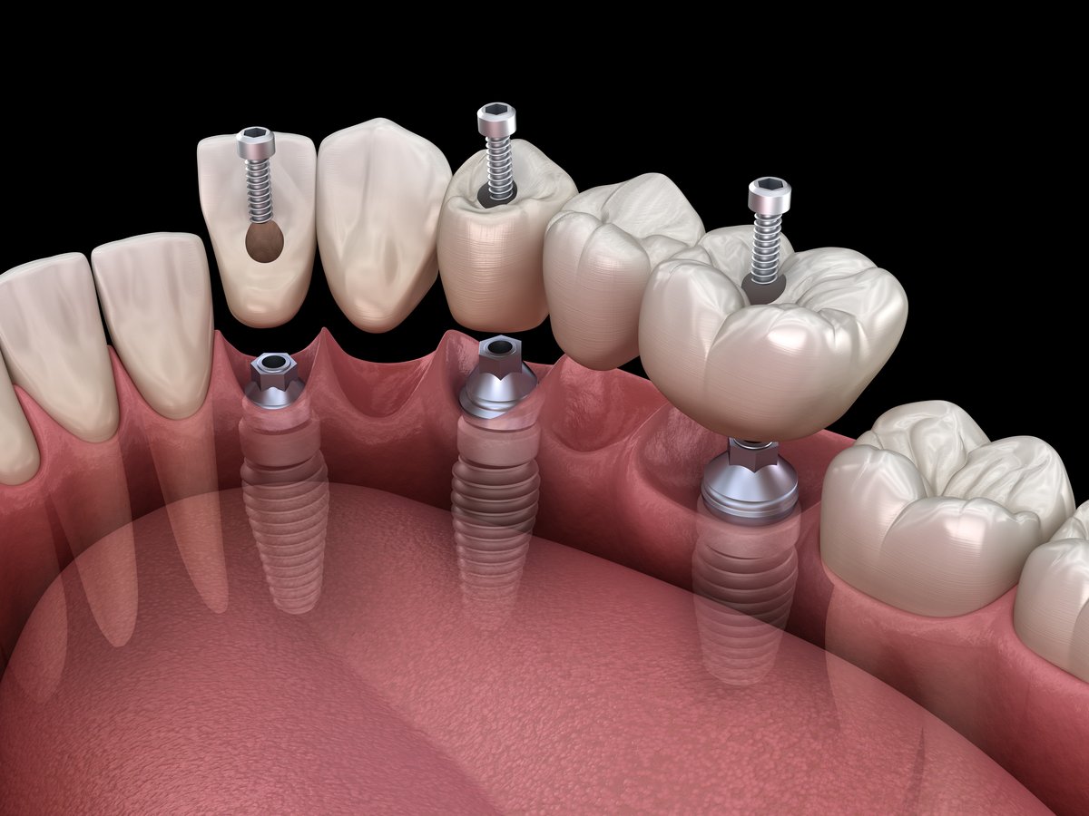 Bridge dentaire fixé sur plusieurs implants
